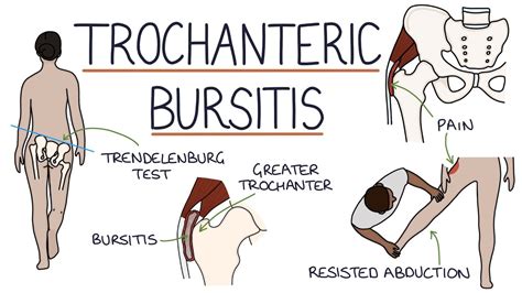 Understanding Trochanteric Bursitis YouTube