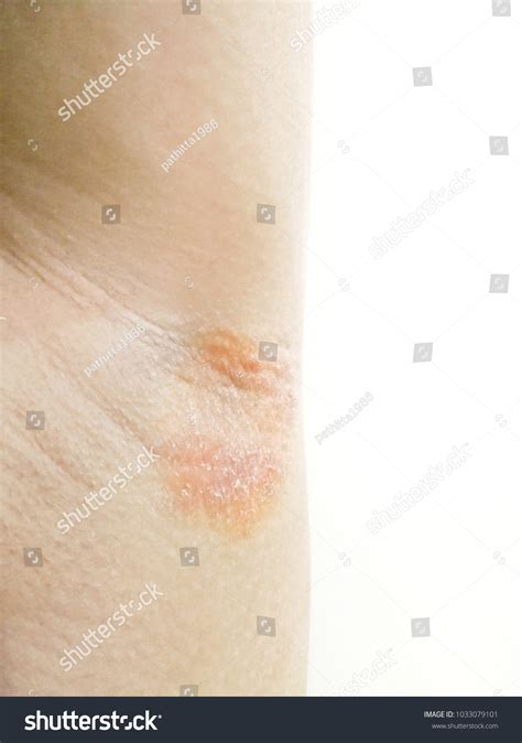 18 Armpit Psoriasis Images Stock Photos And Vectors Shutterstock