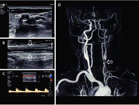 Carotid Ultrasonography Brain Mra In Patient With Takayasu S