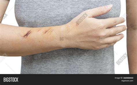 Wound Form Scabs On Image And Photo Free Trial Bigstock