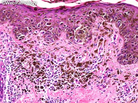 Malignant Melanoma Histology