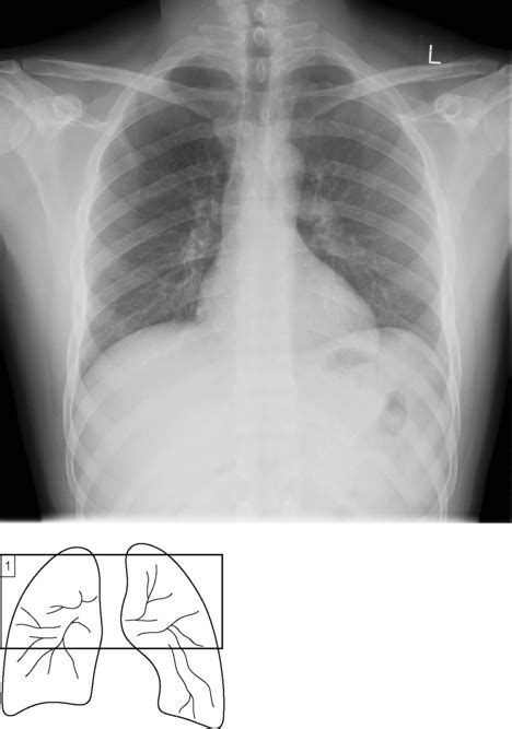 Chest X Ray Pulmonary Embolism