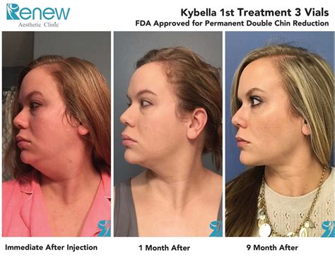 Kybella For Double Chin Renew Aesthetic Clinic And Med Spa