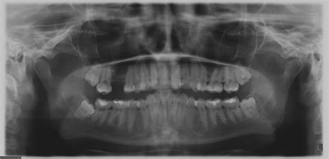 A Preoperative Panoramic Radiograph Of A 27 Year Old Female Patient