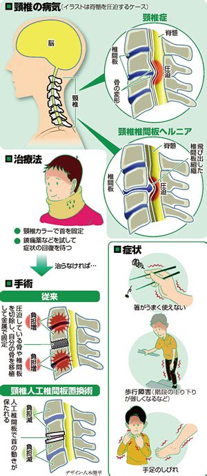 頸椎の病気…首の神経圧迫 手足しびれ : yomiDr./ヨミドクター ...