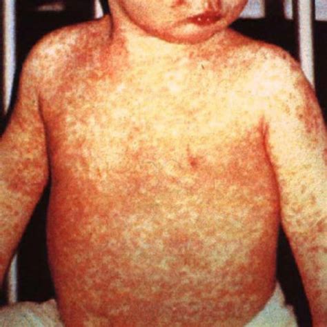 Measles Rash Encyclopedia Of Arkansas