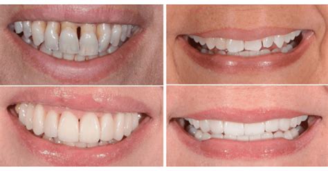 How Dangerous Is Teeth Shaving Bespoke Smile