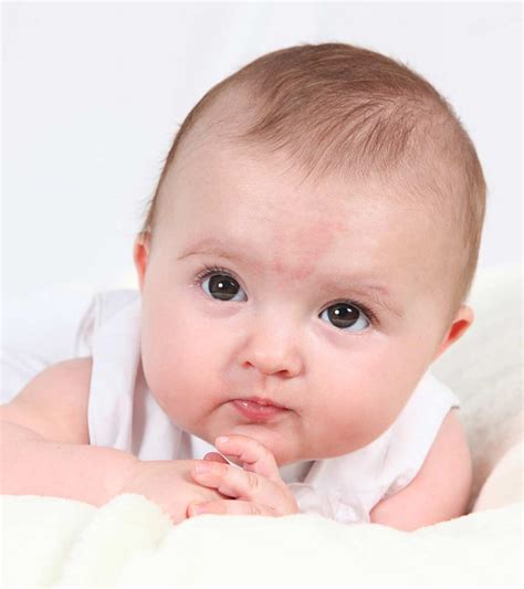 Birthmarks In Babies Causes Types And Treatment
