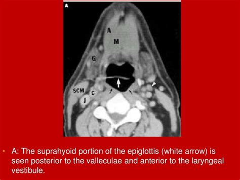 Larynx Imaging 1st Part Laryngeal Anatomy Ct Mri Dr Ahmed Esawy
