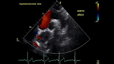 Subcostal Views Transthoracic Echocardiogram Tte Youtube