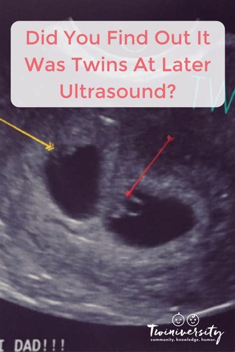 We did not find results for: Did You Find Out It Was Twins At Later Ultrasound ...