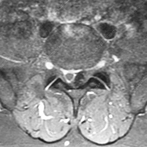 Large Lumbar Disc Herniation Mri Stock Image C0394202 Science