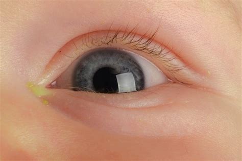 O Que Pode Ser Olhos Remelando No Bebê Tua Saúde