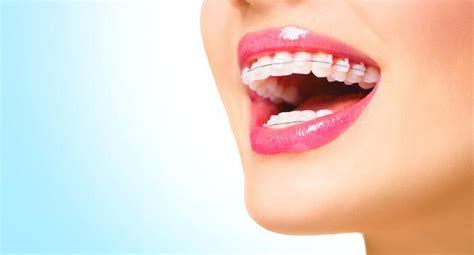 Busting These 5 Myths About Traditional Braces Walied Touni Dds Msd Orthodontist