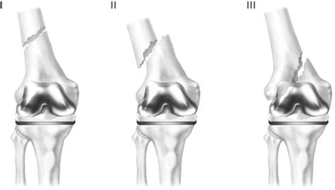 Figure 3 From Periprosthetic Fracture Following Total Knee Arthroplasty