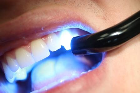 Upaya untuk mengurangi preparasi gigi: 5 Bahan Tambalan Gigi Yang Sering Digunakan | Audy Dental