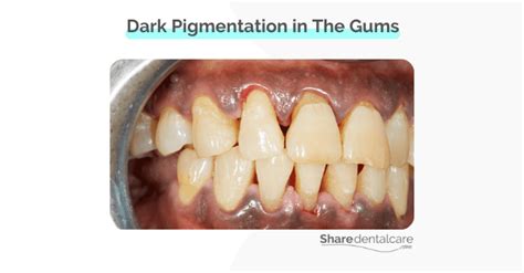 Dark Gums From Smoking Causes And Treatment Share Dental Care