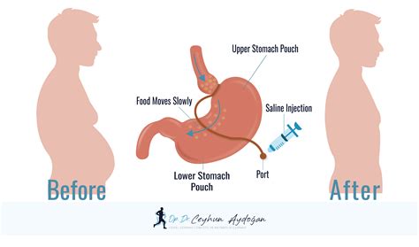 What Are Different Types Of Bariatric Surgery Dr Ceyhun Aydoğan