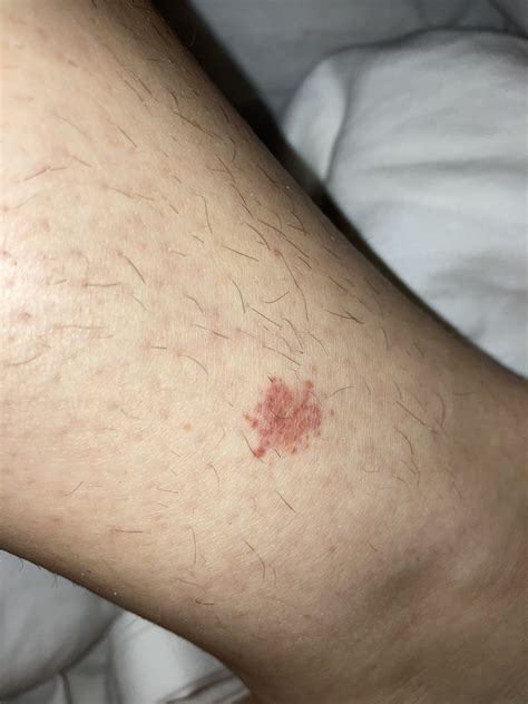 Mystery Red Spot On Leg Should I Get This Checked Out No Pain Or
