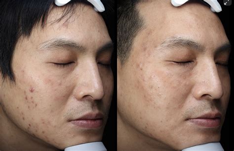 Fractional Resurfacing 67 Degrees Cosmetic Clinic