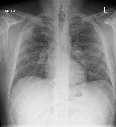 Bilateral Mediastinal Lymphadenopathy With Cough And Shortness Of