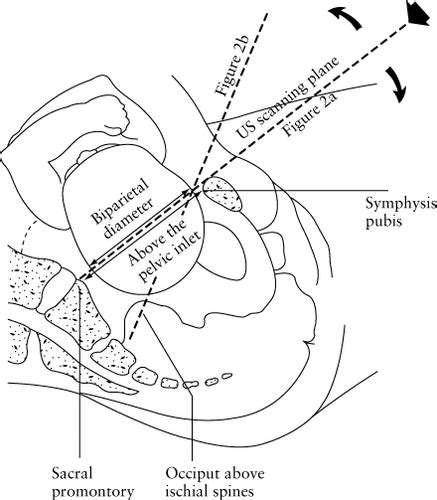 Intrapartum Assessment Of Fetal Head Engagement Comparison Between