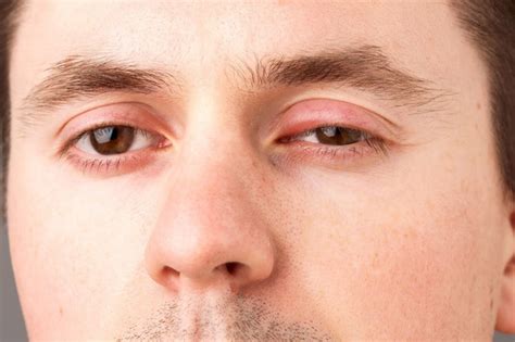 8 Home Remedies To Treat Swollen Eyelids