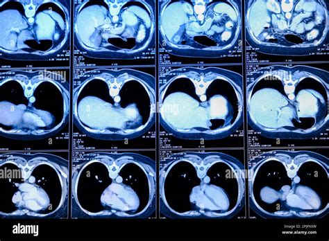 Computed Tomography Ct Scan Of Chest With Abdomen Stock Photo Alamy