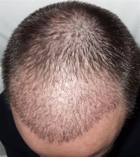 Hair usually begins falling out two to four weeks after you start treatment. Richard - 6000 hairs - HairPalace