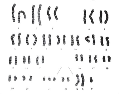 Xxyy Chromosome