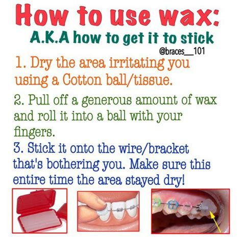 Treatment usually lasts from 18 months to 2 years, and visits to the orthodontist are needed every 6 to 8 weeks. How to use Orthodontic Wax | Orthodontic Emergencies ...