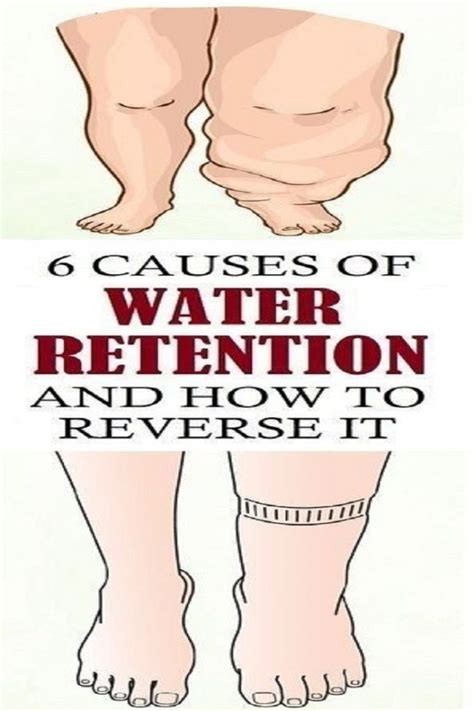 6 Causes Of Water Retention And How To Reverse I Water Retention