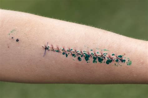 Wound And Stitches On Forearm Stock Image Image Of Detail Incision