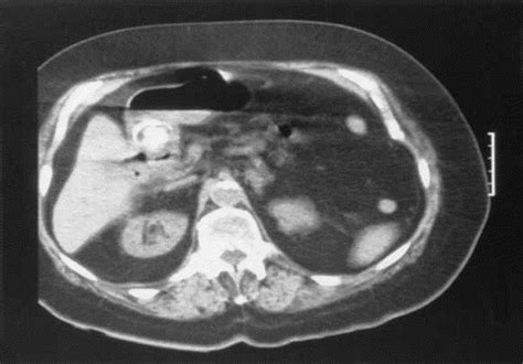 Bouverets Syndrome Gallstone Ileus Causing Gastric Outlet Obstruction