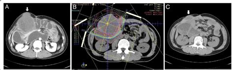 Abdominal Computed Tomography Ct Scan Ct Scan Revealed The Desmoid