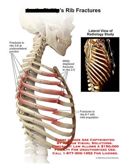 Pain under the ribs in this area can pain under the ribs in this area can indicate a health problem affecting one of these organs or the surrounding tissues. amicus,injury,rib,fractures,costovertebral,junction,displaced,angulation,radiology,osirix | Rib ...
