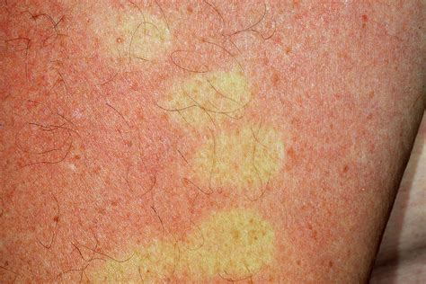 Viral Rash Photograph By Dr P Marazziscience Photo Library