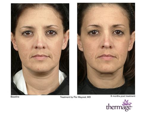 Before And After Face By Thermage™