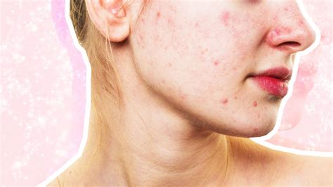 This Could Be The Reason Your Acne Wont Go Away