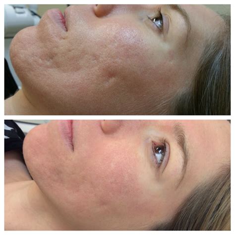 Acne Laser Scar Removal Before And After