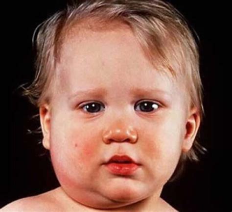 What Is Mumps Disease How It Is Transmitted And What Is Its Tretment
