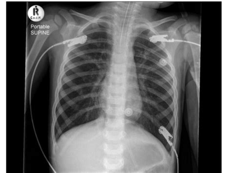 Acute Severe Asthma