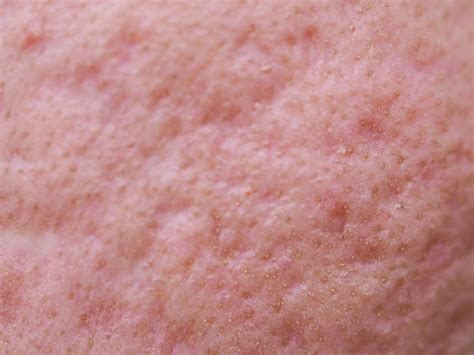 10 Acne Scar Treatments Recommended By The Dermatologist