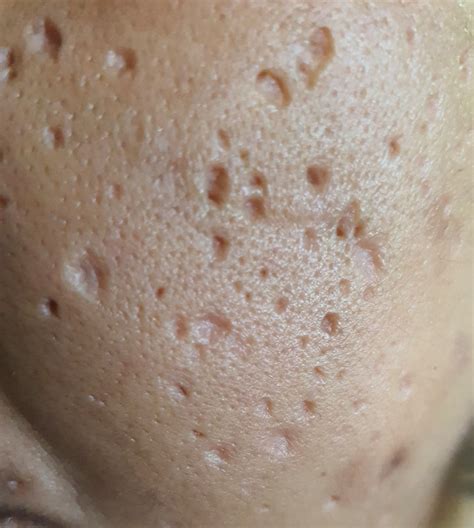 Does Diabetes Type 1 Interfere With Deep Acne Scar Removal Photo Human