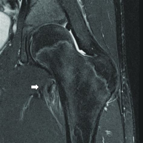 Anteroposterior Radiograph Demonstrating Left Hip Lesser Trochanter