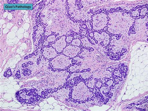 Qiaos Pathology Lobular Neoplasia Alhlcis With Pagetoid Growth In