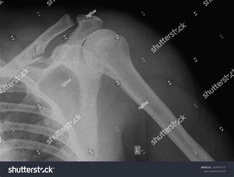 Shoulder X Ray Anatomy Radiology Radiographic Stock Photo 1459919171