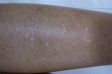 7 doenças que causam manchas brancas na pele Tua Saúde