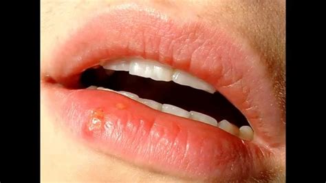 The herpes sores (lesions) typically last a week to 10 days. home remedy for cold sore inside mouth - YouTube