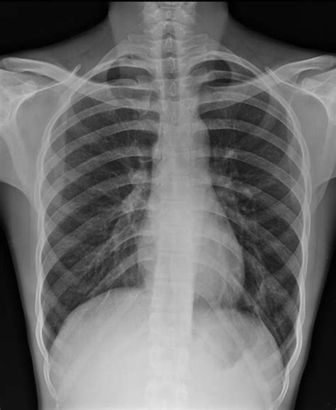 Rib Fracture Radiology Case